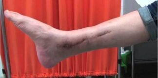 Denuncian mala praxis: operaron a su hijo de una fisura en la tibia y falleció