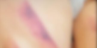 La Paz: Niña de cuatro años golpeada y azotada presuntamente por el Padrastro, quedo detenido