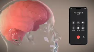 Los chips cerebrales de Elon Musk ya fallaban en animales, según fuentes cercanas a Neuralink