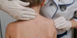 Nueva alerta por sarampión: confirman más casos en Argentina