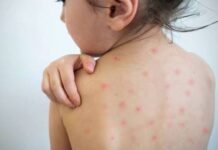 Recomendaciones y prevención de sarampión