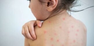 Recomendaciones y prevención de sarampión