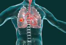 Qué es un adenocarcinoma pulmonar: el diagnóstico que recibió el Papa
